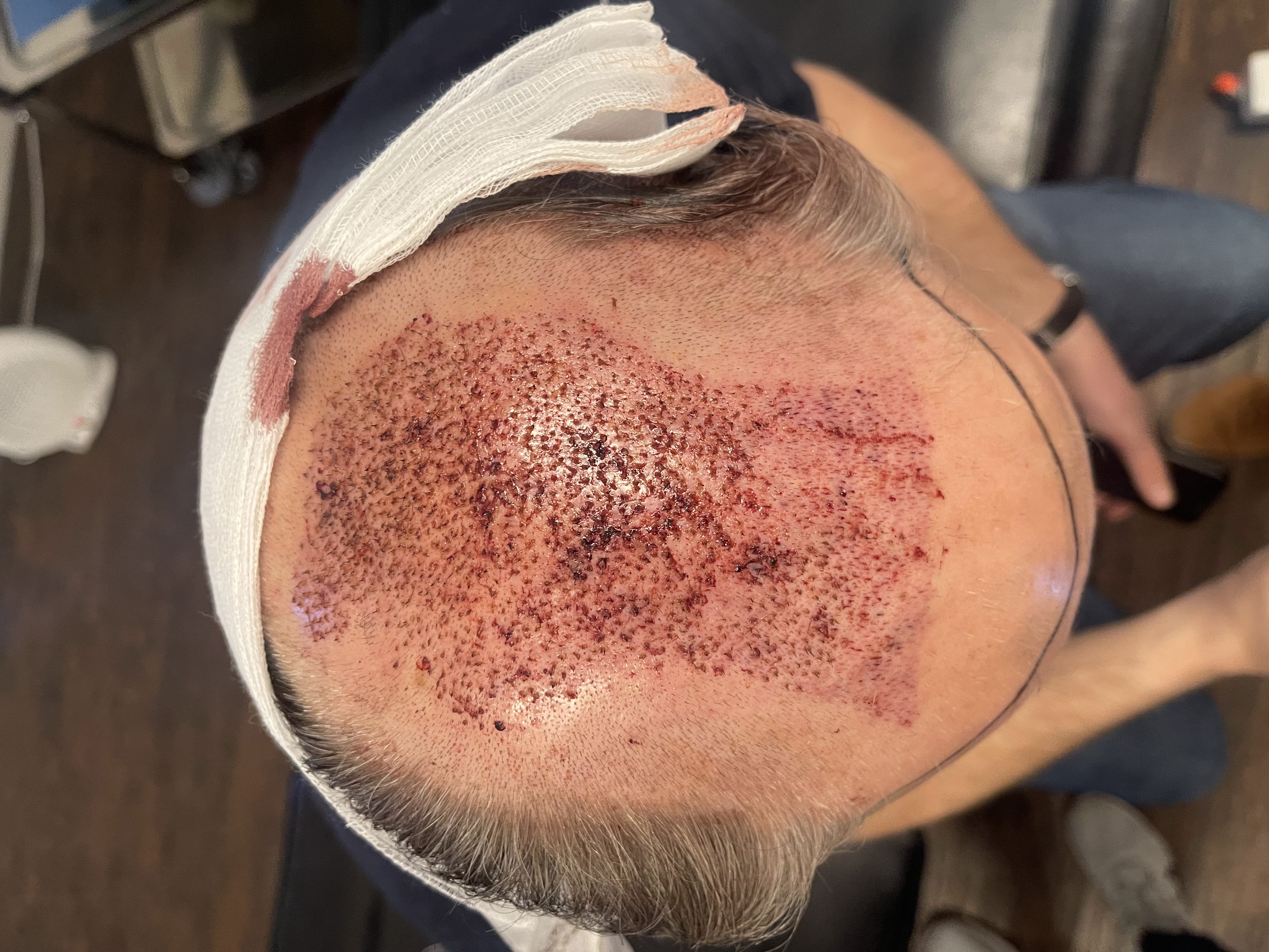 Norwood 7 hair transplant — Colin result photo 5